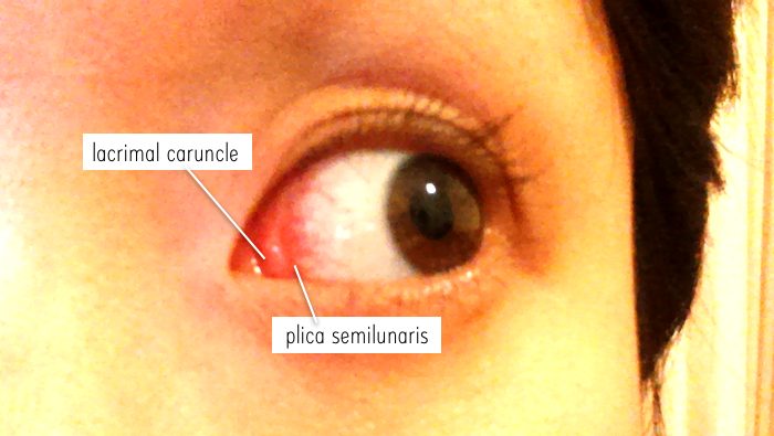swelling and redness in of my lacrimal caruncle and plica semilunaris